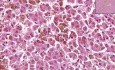 Hemochromatoza-hemosyderoza - histopatologia - wątroba, węzeł chłonny
