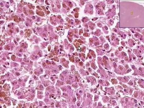 Hemochromatoza-hemosyderoza - histopatologia - wątroba, węzeł chłonny