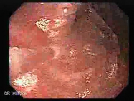Gruczolakorak żołądka - wczesne stadium - endoskopia (1 z 5)