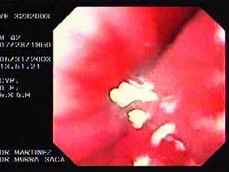 Żołądek klepsydrowaty - skurcz proksymalnej części trzonu żołądka - prezentacja miejsca zwężenia