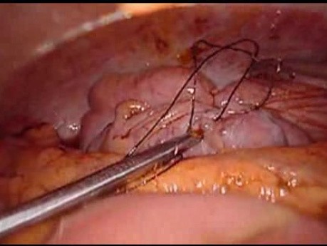 Perforacja okrężnicy z zapaleniem otrzewnej - laparoskopia (19 z 46)