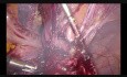 Histerektomia laparoskopowa. Stan po 3 cięciach cesarskich.