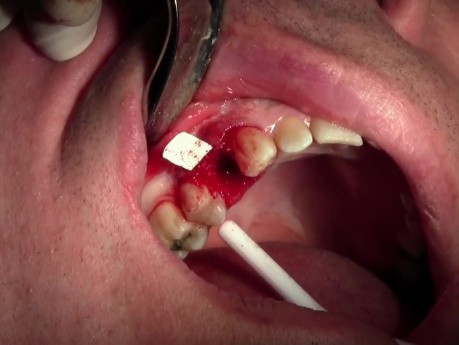 Ekstrakcja zęba 1-5 z jednoczesnym przeszczepem kostnym - d-PTFE