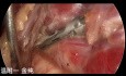 Dwuportowa przezpodobojczykowa endoskopowa operacja tarczycy (część 5)