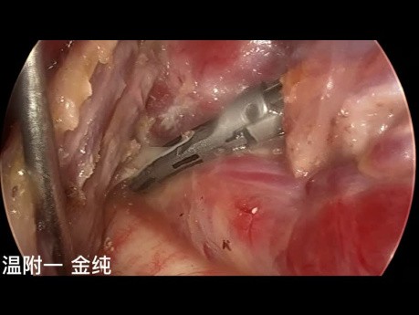 Dwuportowa przezpodobojczykowa endoskopowa operacja tarczycy (część 5)