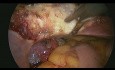 Całkowite laparoskopowe wycięcie macicy z przydatkami u pacjentki po cięciu cesarskim