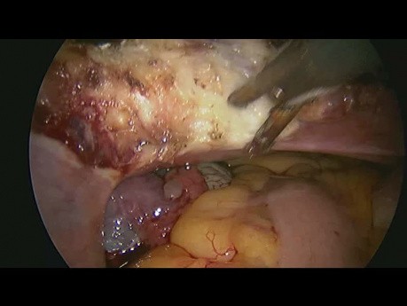 Całkowite laparoskopowe wycięcie macicy z przydatkami u pacjentki po cięciu cesarskim