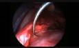 Endoskopowe wycięcie guza przygardłowego