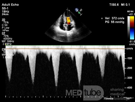 Kardiomiopatia przerostowa z zawężaniem drogi odpływu lewej komory