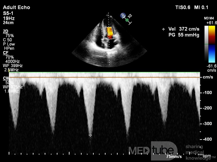 Kardiomiopatia przerostowa z zawężaniem drogi odpływu lewej komory