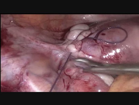 Laparoskopowa miomektomia w przypadku mięśniaka w więzadle szerokim macicy
