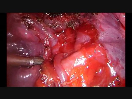 Wideotorakoskopowe usunięcie płata dolnego płuca lewego w technice fissure-less