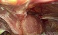 Chirurgie d’un isthmocèle post-césarienne