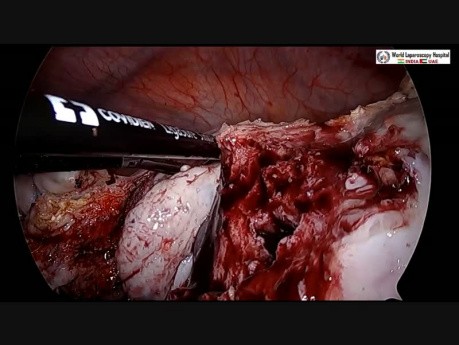 Pierwsza na świecie laparoskopowa operacja usunięcia 3,5 kg mięśniaka macicy, torbieli jajnika, pęcherzyka żółciowego i wyrostka robaczkowego