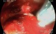 Guz brodawki Vatera - leczenie endoskopowe