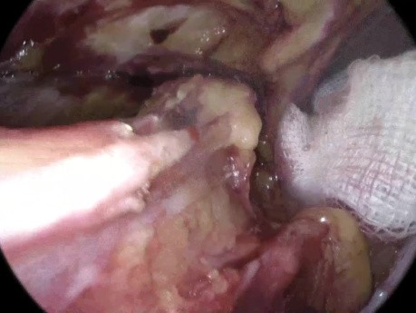 Laparoskopowa operacja przepuklin pachwinowych metodą TAPP - anatomia 