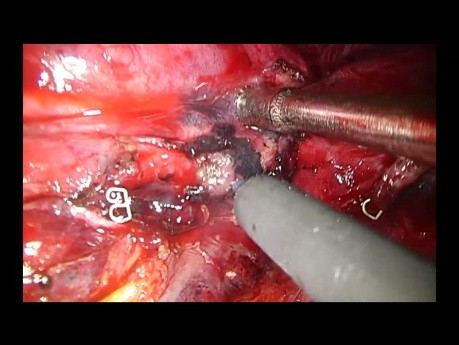 Lobektomia rękawowa dolna prawostronna metodą Uniportal VATS