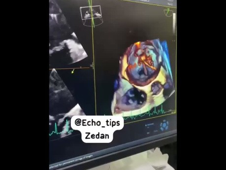 Echokardiografia przezprzełykowa 3D w przezskórnej balonowej walwuloplastyce mitralnej