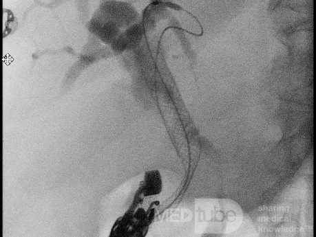 Endoskopowa choledochoduodenostomia pod kontrolą EUS [4/7]