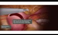 Animacja laparoskopowej miomektomii wraz z 3-warstwowym zamknięcie za pomocą dwukierunkowego szwu kolczastego Quill®