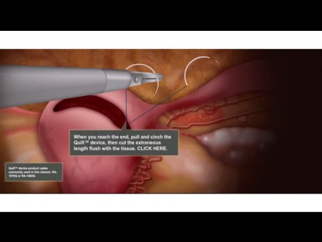 Animacja laparoskopowej miomektomii wraz z 3-warstwowym zamknięcie za pomocą dwukierunkowego szwu kolczastego Quill®