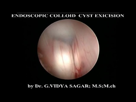Endoskopowe wycięcie torbieli koloidowej