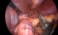 GIST okolicy podwpustowej -Klinowa resekcja żołądka 