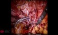 Reparación robótica de una hernia traumática de la pared abdominal