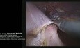 Bariatria - operacja rewizyjna po pierwotnym założeniu opaski nieregulowanej