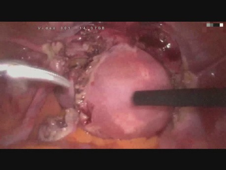 SLH - laparoskopowe usunięcie trzonu macicy, morcelacja macicy w worku