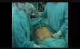 Wprowadzanie trokarów - laparoskopowa radykalna prostatektomia