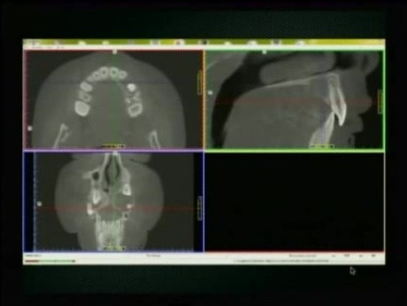 CBCT w analizie i planowaniu zabiegów chirurgiczno-implantologicznych - część 2