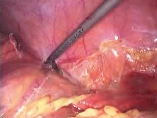 Hemikolektomia laparoskopowa lewostronna z powodu guza okrężnicy