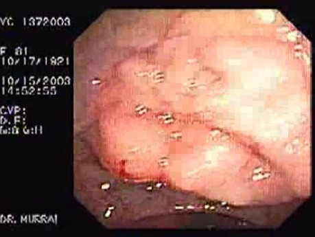 Gruczolak cewkowo - kosmkowy - endoskopia (3 z 28)