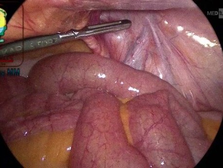 Olbrzymia prawostronna bezpośrednia przepuklina pachwinowa