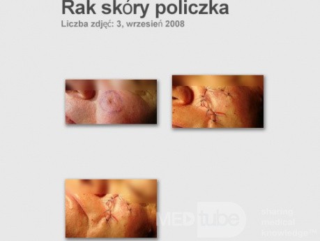 Rak podstawnokomórkowy skóry