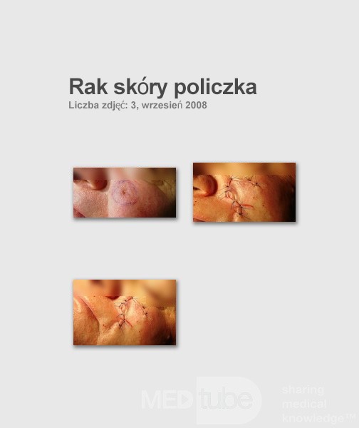 Rak podstawnokomórkowy skóry