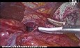 Laparoskopowe leczenie całkowicie wewnątrzklatkowego żołądka