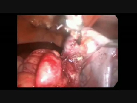 Ciąża pozamaciczna zlokalizowana w jamie otrzewnej- laparoskopia
