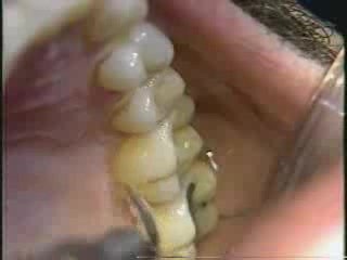 Ultradźwiękowe oczyszczanie zębów