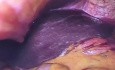Laparoskopowa gastrostomia w zwężającym raku przełyku