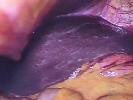 Laparoskopowa gastrostomia w zwężającym raku przełyku