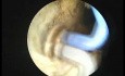 Elektroda TUVis - leczenie schorzeń prostaty