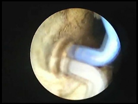 Elektroda TUVis - leczenie schorzeń prostaty