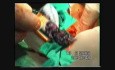 Operacja raka przełyku - ezofagektomia