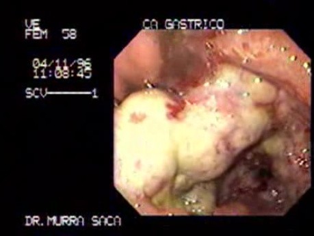 Gruczolakorak żołądka z centralną martwicą - endoskopia
