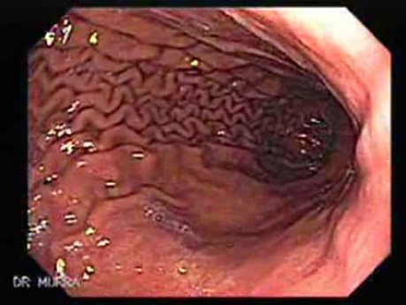 Fałdy żołądkowe - obraz endoskopowy