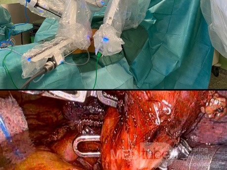 Chirurgia robotowa w operacji raka płuca