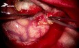 Hemostaza loży po usuniętym guzie (Glio-blastoma, prawa półkula mózgu) za pomocą TachoSil