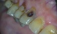 Dostęp endodontyczny do kła szczęki od strony wargowej